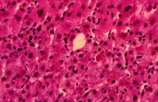 Характерные изменения при циррозе печени. Дистрофия гепатоцитов при остром гепатите; микропрепарат.