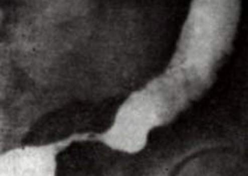 Рентгеноскопия: малигнизированная стриктура дистального отдела прямой кишки при неспецифическом язвенном колите