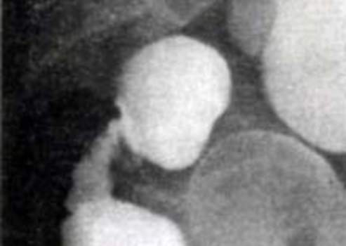 Рентгеноскопия: сужение просвета верхнеампулярного отдела – эндофитный рак прямой кишки