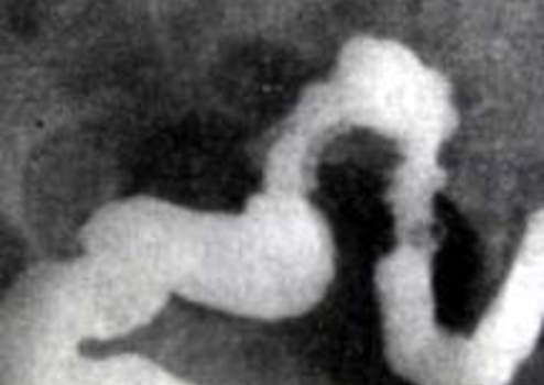 Рентгеноскопия: эндометриоз дистального отдела сигмовидной и  верхнеампулярного отдела прямой кишки
