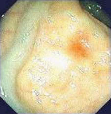 Ректоскопия: расширение вены прямой кишки у больной, страдающей циррозом печени. фото 1.