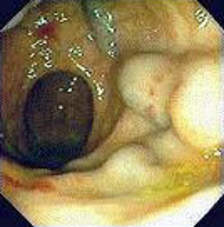 Ректоскопия: расширение вены прямой кишки у больной, страдающей циррозом печени
