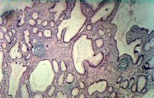 Воспалительный полип слизистой прямой кишки: множественные мелкие кисты (микропрепарат)