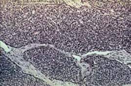 Злокачественная базалиома заднего прохода: эпителиальная опухоль, возникающая из базальных клеток мальпигиевого слоя кожи ( микропрепарат)