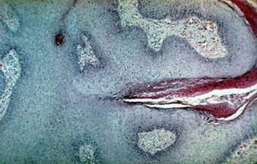 Венерическая бородавка (кондилома остроконечная): эпителиальные клетки хорошо дифференцированы, определяется четкая граница между эпидермисом и дермой, в которой отмечаются небольшие инфильтраты из плазматических клеток и лимфоцитов