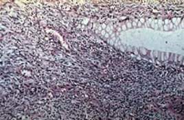 Злокачественная меланома аноректальной зоны: выраженный полиморфизм клеток, расположенных беспорядочно и формирующих структуры альвеолярного типа (микропрепарат)