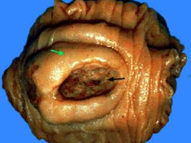 Лейомиосаркома прямой кишки: центральная язва (черная стрелка) - некротизированная опухоль, залегающая в стенке кишки, рельефно выступающая ткань вокруг язвы (зеленая стрелка) - неизмененная слизистая оболочка с гладкой поверхностью (макропрепарат)