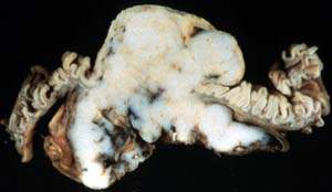 Поверхность среза лейомиосаркомы, имеющая вид рыбьего мяса, с некрозом (макропрепарат)