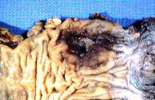 Эндофитно-язвенная форма рака ампуллярного отдела прямой кишки (макропрепарат)