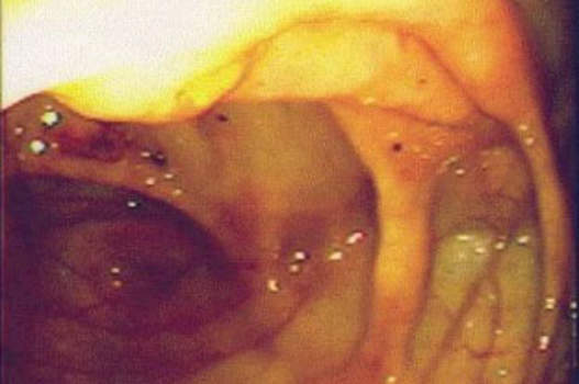 Колоноскопия: вид неизмененного илеоцекального клапана со стороны ободочной кишки.