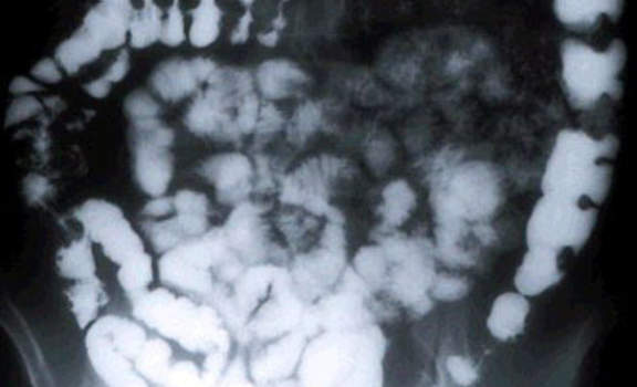 Рентгеноскопия: подвздошная кишка, заполненная водорастворимым контрастным веществом.