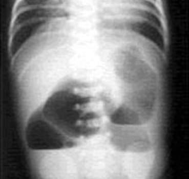 Рентгеноскопия: раздутые петли тонкой кишки в правой половине брюшной полости.