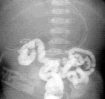 Рентгеноскопия: введенное через прямую кишку контрастное вещество заполняет ободочную кишку и не проходит выше.