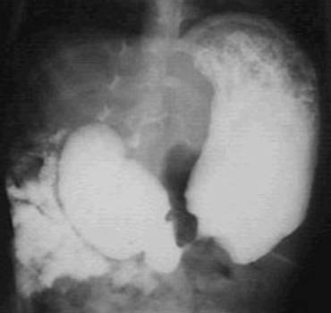 Рентгеноскопия: тонкая кишка располагается в правой половине брюшной полости, в подпеченочном пространстве.