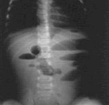 Рентгенография: множественные горизонтальные уровни жидкости со скопившимся над ними газом. В ободочной кишке газ отсутствует.