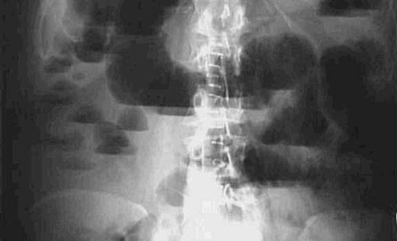Рентгенография: множественные горизонтальные уровни жидкости в петлях тонкой кишки.