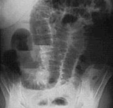 Рентгенография: в растянутых петлях кишки видны складки слизистой оболочки.