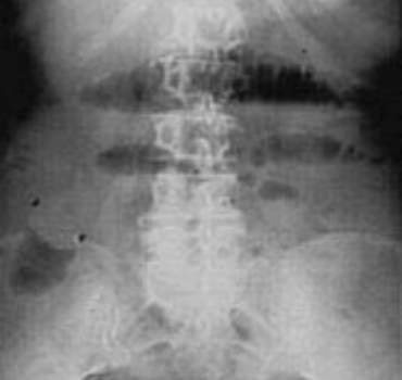 Рентгенография: уровни жидкости при тонкокишечной непроходимости.