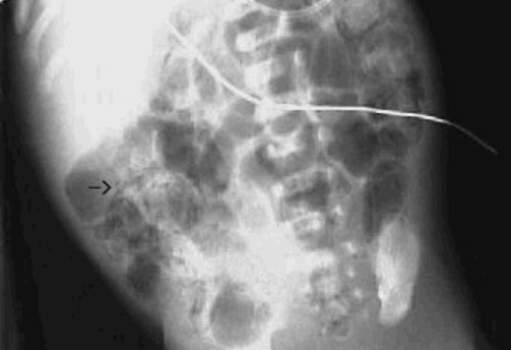 Рентгеноскопия: участок пневматоза тонкой кишки у новорожденного.