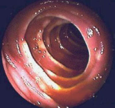 Эндоскопия: эрозивный еюнит у пациента, перенесшего гастрэктомию. На слизистой оболочке тощей кишки видны белесоватые поверхностные эрозии.