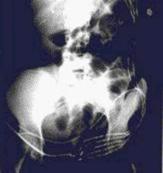 Рентгеноскопия: множественные горизонтальные уровни жидкости в петлях тонкой кишки у пациентки, страдающей целиакией.