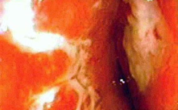 Эндоскопия: картина поражения дистальной части подвздошной кишки при болезни Крона.
