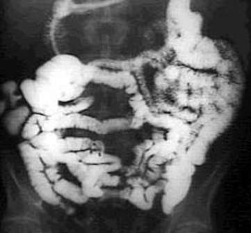 Рентгеноскопия: небольшой дефект наполнения, свидетельствующий о подслизистом положении новообразования.