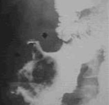Рентгеноскопия: дефект наполнения тонкой кишки с неровными краями – изъязвленная нейрофиброма кишечника у пациентки, страдающей нейрофиброматозом.