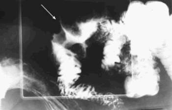 Рентгеноскопия: дефект наполнения с нервными краями – аденокарцинома проксимального отдела тощей кишки, расположенная сразу после связки Трейтца.