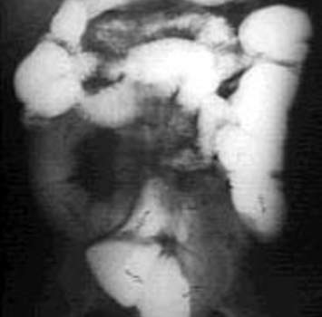 Рентгеноскопия: картина стеноза тонкой кишки у больного, оперированного по поводу периаппендикулярного абсцесса.