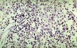 Брюшной тиф: гранулема из крупных макрофагальных (брюшнотифозных) клеток при мозговидном набухании групповых фолликулов (микропрепарат).