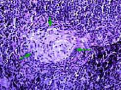 Болезнь Крона: гранулема, состоящая из эпителиоидных гистиоцитов, сформированная в лимфоузле, с гигантскими клетками (зеленые стрелки) и без признаков некроза (микропрепарат).