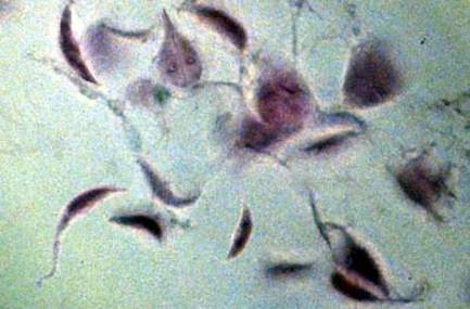 Giardia lamblia, инфицирующая тонкую кишку (микропрепарат).