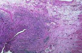 Болезнь Крона: лимфогистиоцитарная инфильтрация кишечной стенки (микропрепарат).