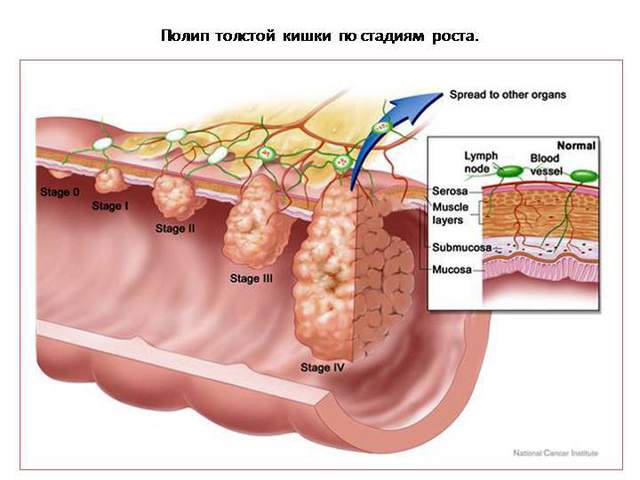 Слабые мышцы повышают риски при раке толстой кишки