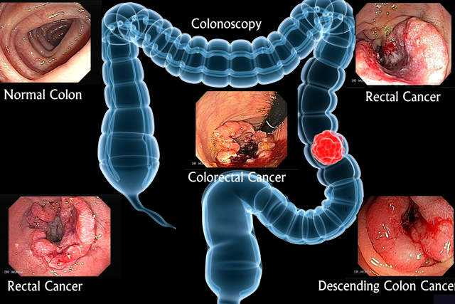 Ученые по-новому взглянули на рост колоректального рака