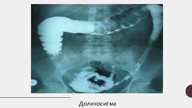 О долихосигме и запорах