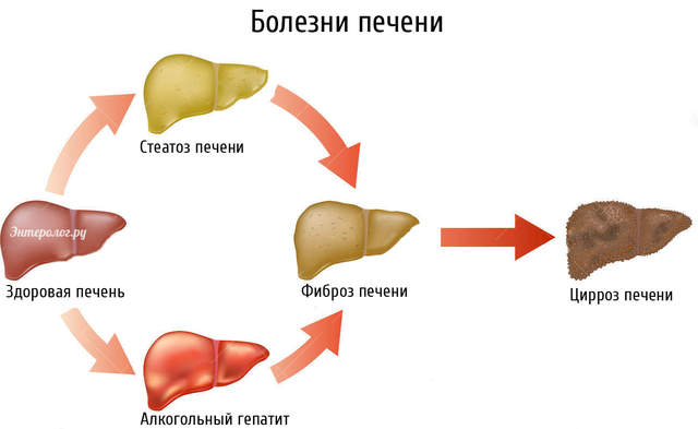 Высокий сахар в крови может провоцировать заболевания печени