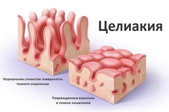 Замаскированная целиакия – причина многих не ясных желудочно-кишечных растройств и нарушений обмена веществ у взрослых