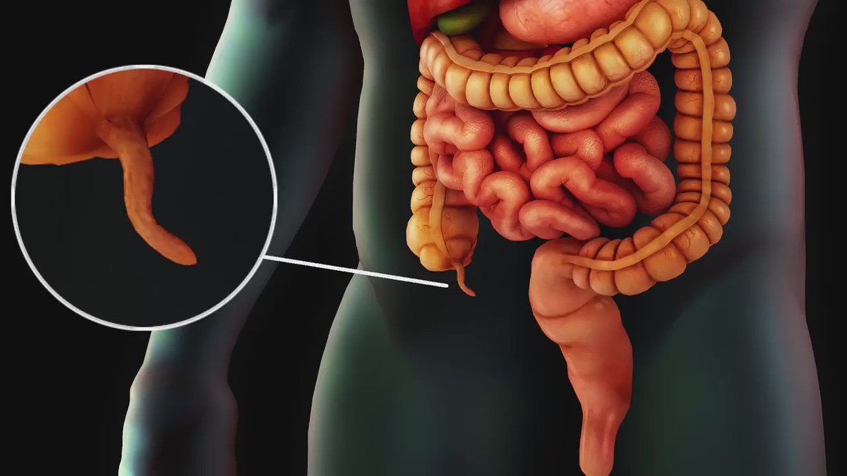 Где аппендицит картинка